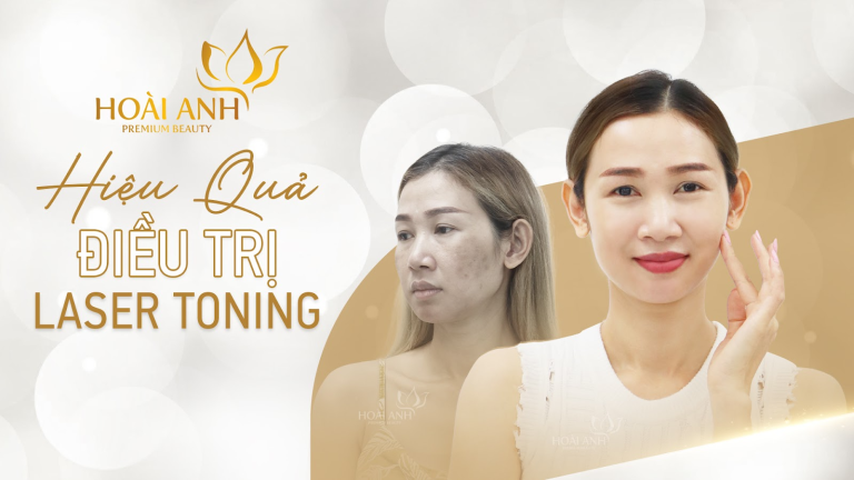 TMV HOÀI ANH – ĐIỀU TRỊ NÁM LASER BẰNG CÔNG NGHỆ MỚI